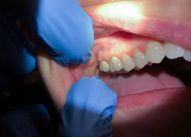 Best Emergency Dental Care for Abscessed Tooth in Temple Hills, MD