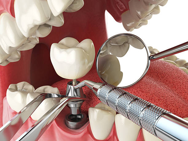 Best Emergency Dentist for Lost Fillings or Crowns in Temple Hills, MD